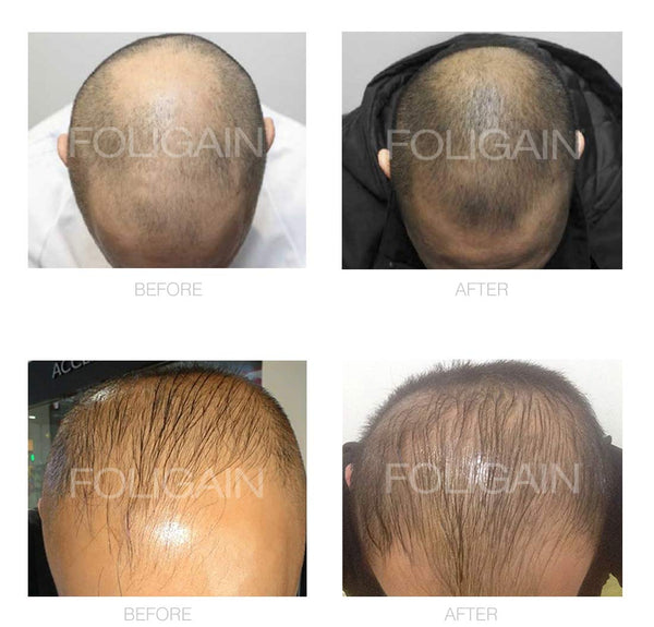 FOLIGAIN Low Alcohol Minoxidil 5% Hair Regrowth Treatment For Men 12 Month Supply - FOLIGAIN EU