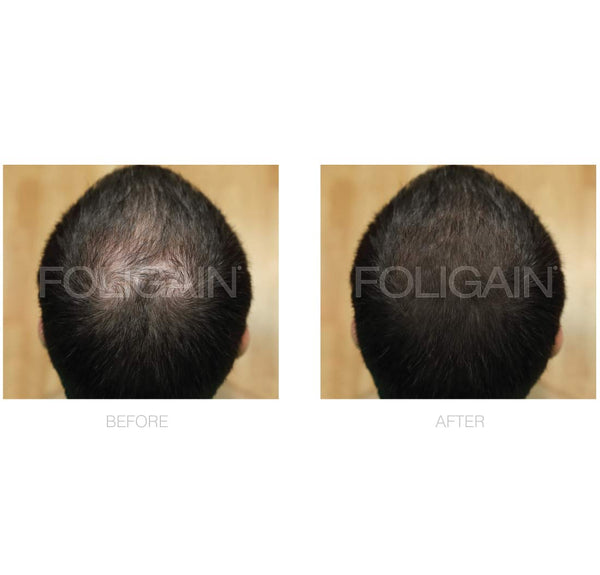 FOLIGAIN Low Alcohol Minoxidil 5% Hair Regrowth Treatment For Men - FOLIGAIN EU