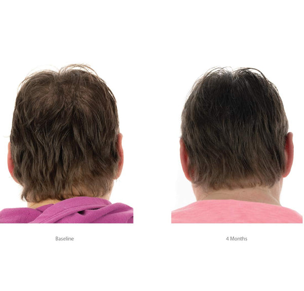 FOLIGAIN Triple Action Shampoo für dünner werdendes Haar für Frauen mit 2 % Trioxidil