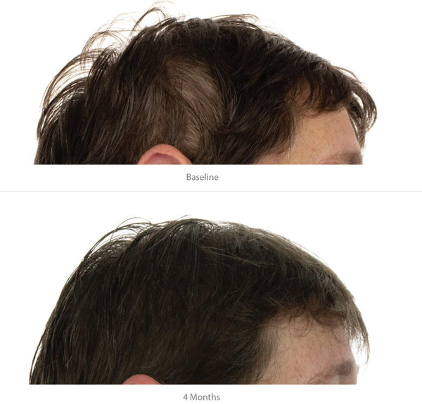 FOLIGAIN Triple Action Shampoo für dünner werdendes Haar für Frauen mit 2 % Trioxidil